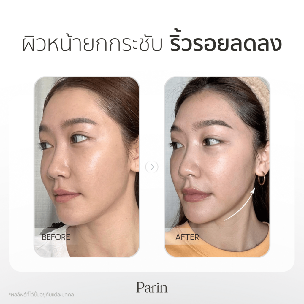 วิธีรักษาริ้วรอยบนใบหน้า